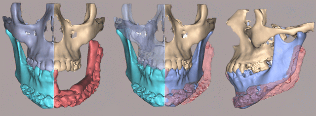 Scan d'une machoire représenté en 3D chirurgie maxilo faciale