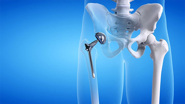 prothèse hanche, chirurgie orthopédique