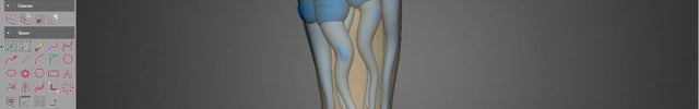 Design de prothèse orthopedique logiciel 3D