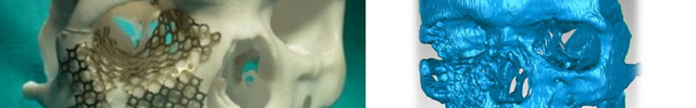 prothèse maxilo facial imprimée en 3D