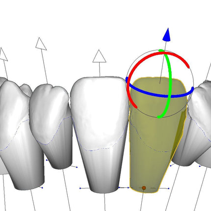 Logiciel-Logiciel de Conception 3D de gouttières aligneurs pour l'Orthodontie DeltaFace Aligner- DELTAFACE - KALLISTO