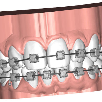 Logiciel-Logiciel Deltaface Indirect Bonding (IBT) pour l'impression 3D de Gouttières de positionnement de Brackets- DELTAFACE - KALLISTO