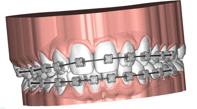 Logiciel-Logiciel Deltaface Indirect Bonding (IBT) pour l'impression 3D de Gouttières de positionnement de Brackets- DELTAFACE - KALLISTO