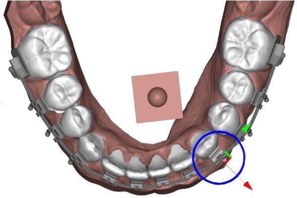 Logiciel-Logiciel Deltaface Indirect Bonding (IBT) pour l'impression 3D de Gouttières de positionnement de Brackets- DELTAFACE - KALLISTO