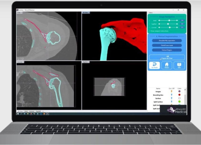 Logiciel-Logiciel Rhino3DMedical Dicom vers Stl (IRM)- MIRRAKOI - KALLISTO