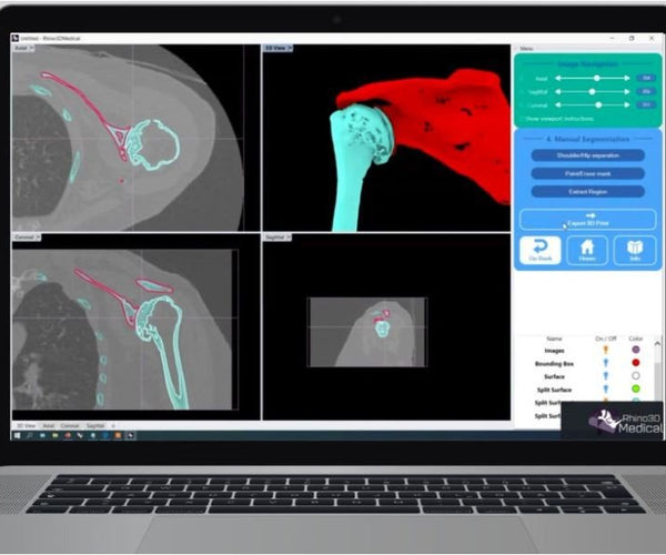 Logiciel Rhino3DMedical Dicom vers Stl (IRM)