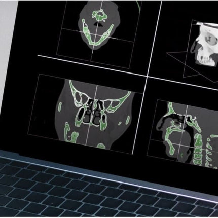 Logiciel-Logiciel Rhino3DMedical Dicom vers Stl (IRM)- MIRRAKOI - KALLISTO